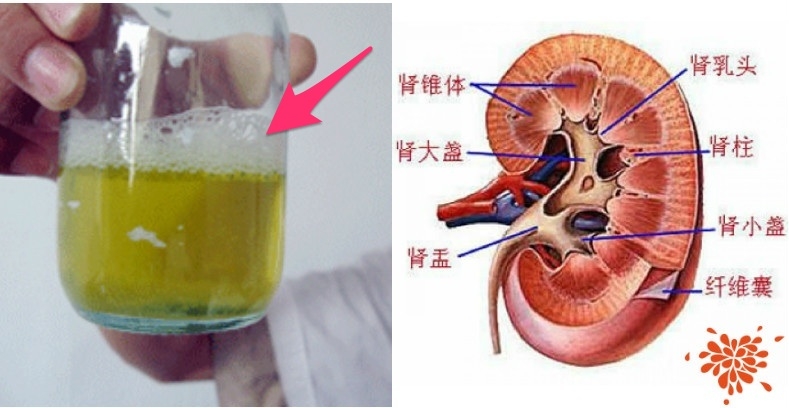 如果看到尿液中「泡泡变多」,这是大病前兆!等到