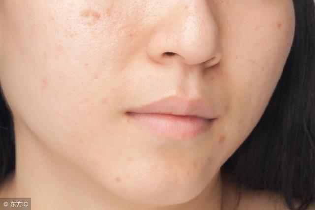 毛孔粗大的最主要的原因是皮肤上的角质越积越多,如果角质越积越多的