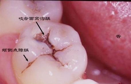 為什麼牙齒上會有洞?太可怕!